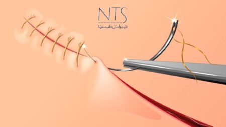 علت سوزش بخیه بعد از جراحی