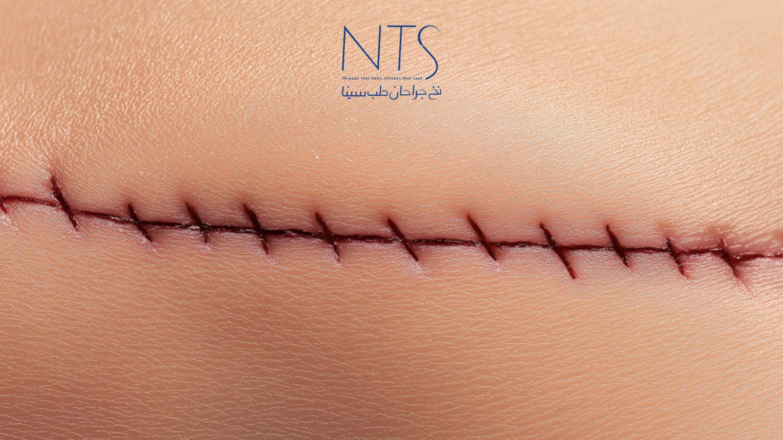 بخیه بعد از جراحی