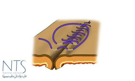 بخیه زنی
