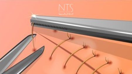 زمان برداشتن نخ بخیه غیرجذبی پس از جراحی