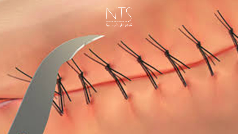 نخ بخیه غیرجذبی